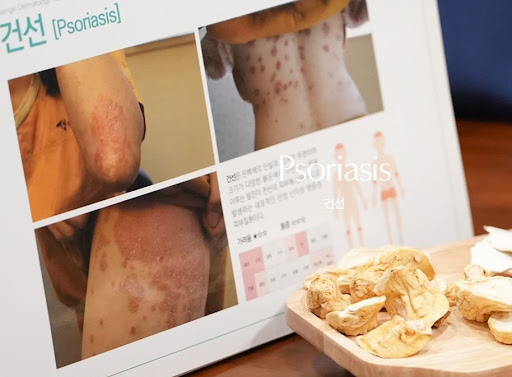 생기한의원이 설명하는 건선 각질 제거 시 주의해야 할 이유