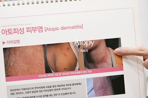 생기한의원으로 알아보는 아토피 증상 개인차가 크게 나타나는 이유